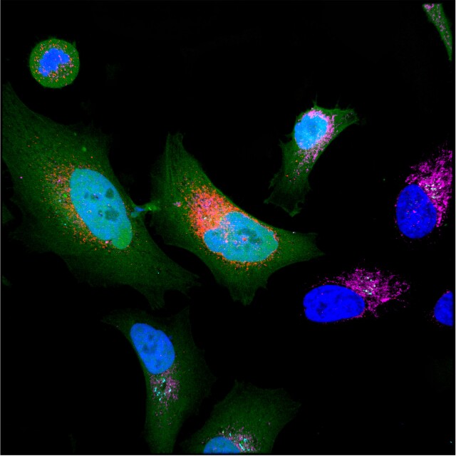 CancerCellExpressingMicroprotein